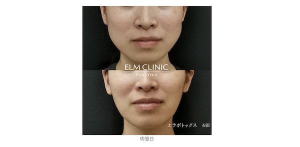 エルムクリニック　症例写真　エラボトックス https://www.elm-clinic.jp/treatment/botox_slimface/