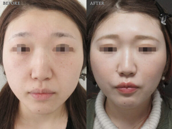 ジョウクリニック　症例写真　エラボトックス https://www.joeclinic.jp/case/anti-aging-botox-2/