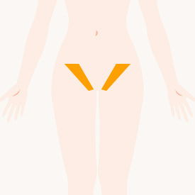 Vライン（サイド）