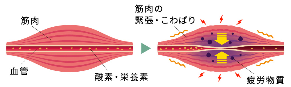 肩こりの原因イラスト