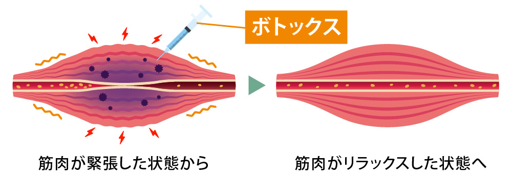 多汗書ボトックスの施術部位と注入量の目安