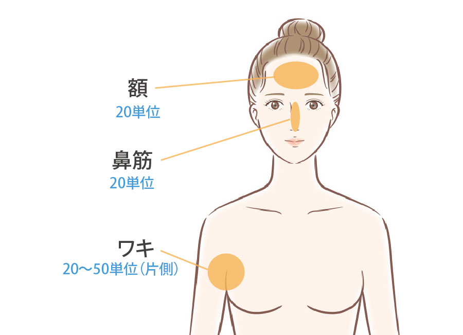 多汗書ボトックスの施術部位と注入量の目安