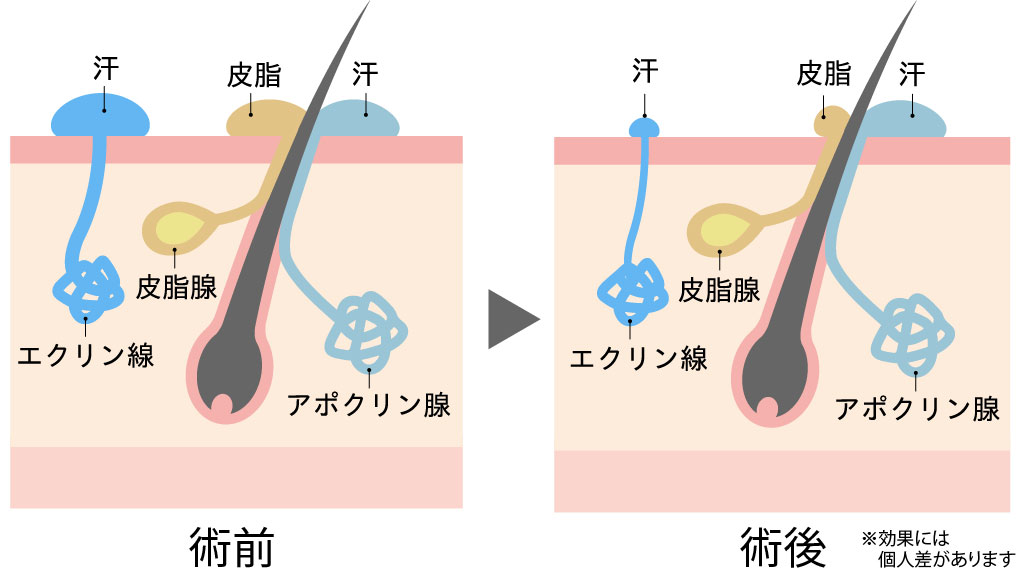 多汗書ボトックスの施術部位と注入量の目安