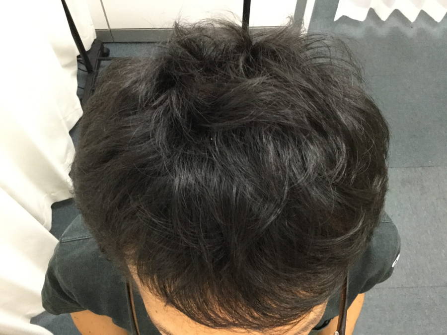 【AGA】内服薬HairReactive®とメソセラピーで薄毛を大幅改善【症例写真】