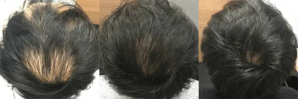 AGA治療_症例_AGAヘアクリニック