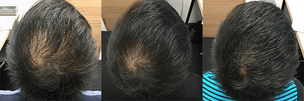 AGA治療_症例_AGAヘアクリニック