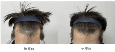 AGA治療_症例_駅前AGAクリニック