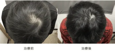 AGA治療_症例_駅前AGAクリニック