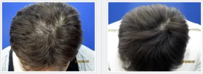 AGA治療_症例_池袋AGAクリニック