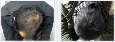 AGA治療_症例_池袋AGAクリニック