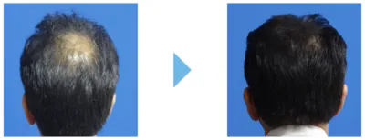 AGA治療_症例_東京中央美容外科AGA専門外来
