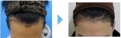 AGA治療_症例_東京中央美容外科AGA専門外来