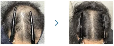 AGA治療_症例_ウィルAGAクリニック