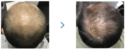 AGA治療_症例_ウィルAGAクリニック