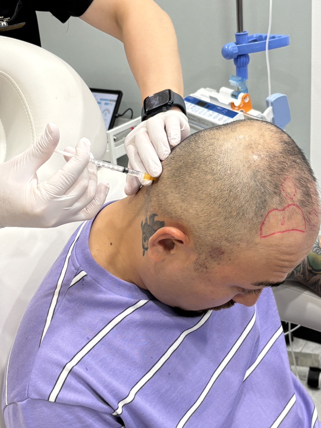 頭皮PRP注射・メソセラピー（新メニュー）