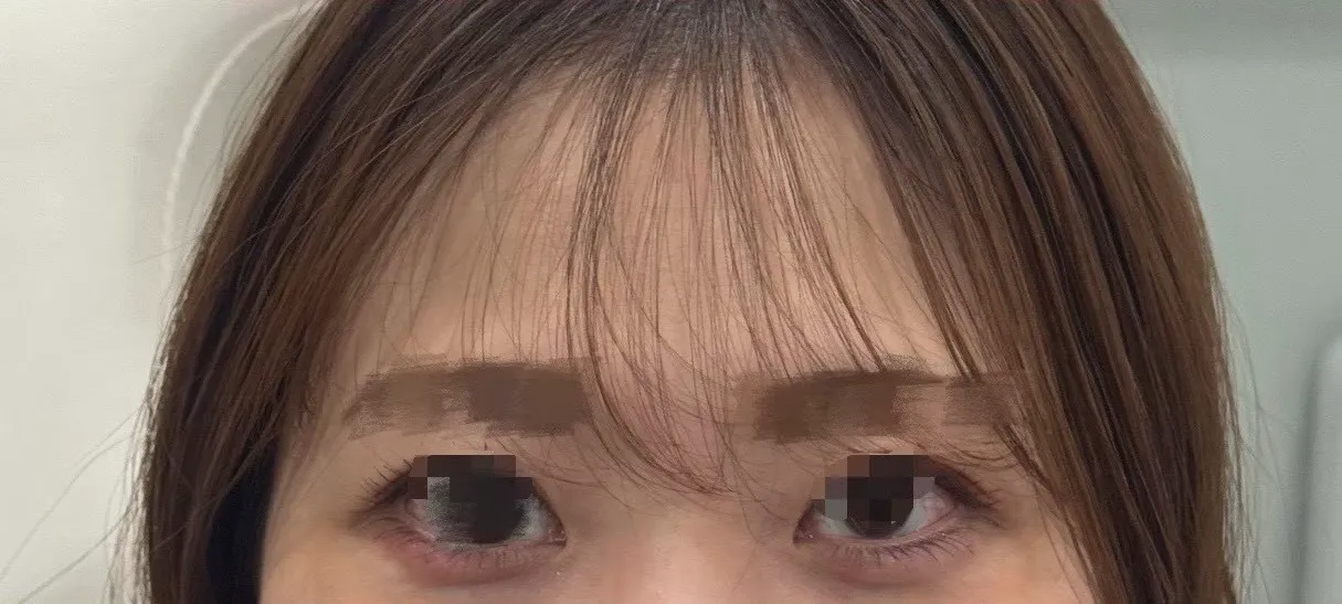ヒアルロン酸　ジュビダームビスタ®ボルベラ　涙袋【症例写真】