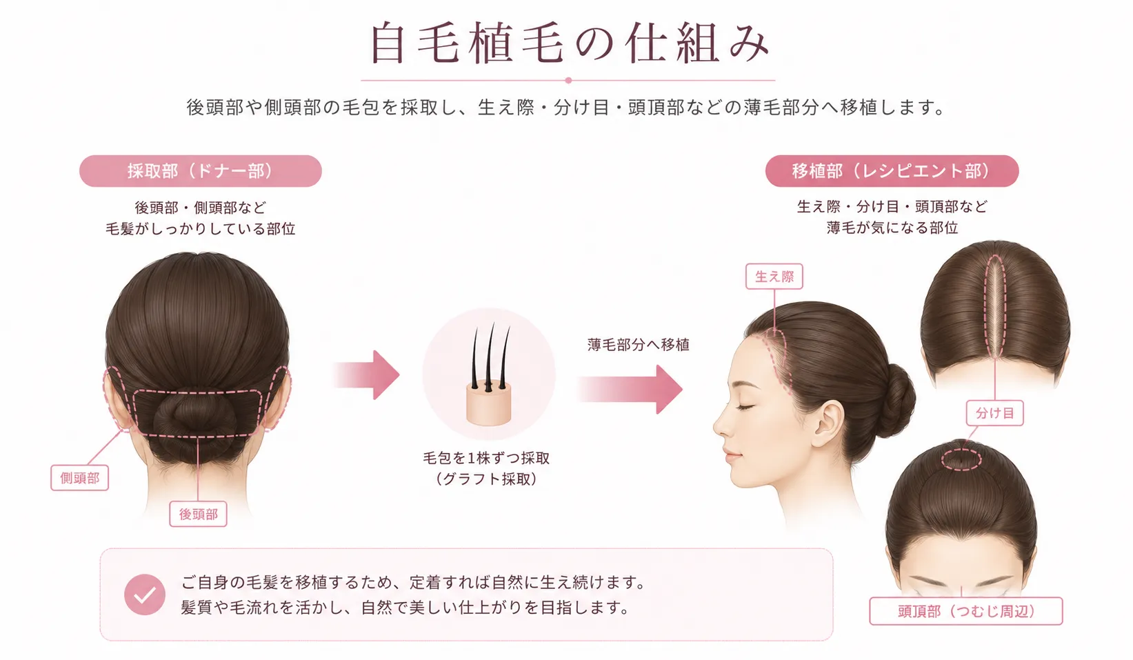 後頭部または側頭部から毛包を採取し、生え際や頭頂部へ移植する自毛植毛の仕組みを示す模式図