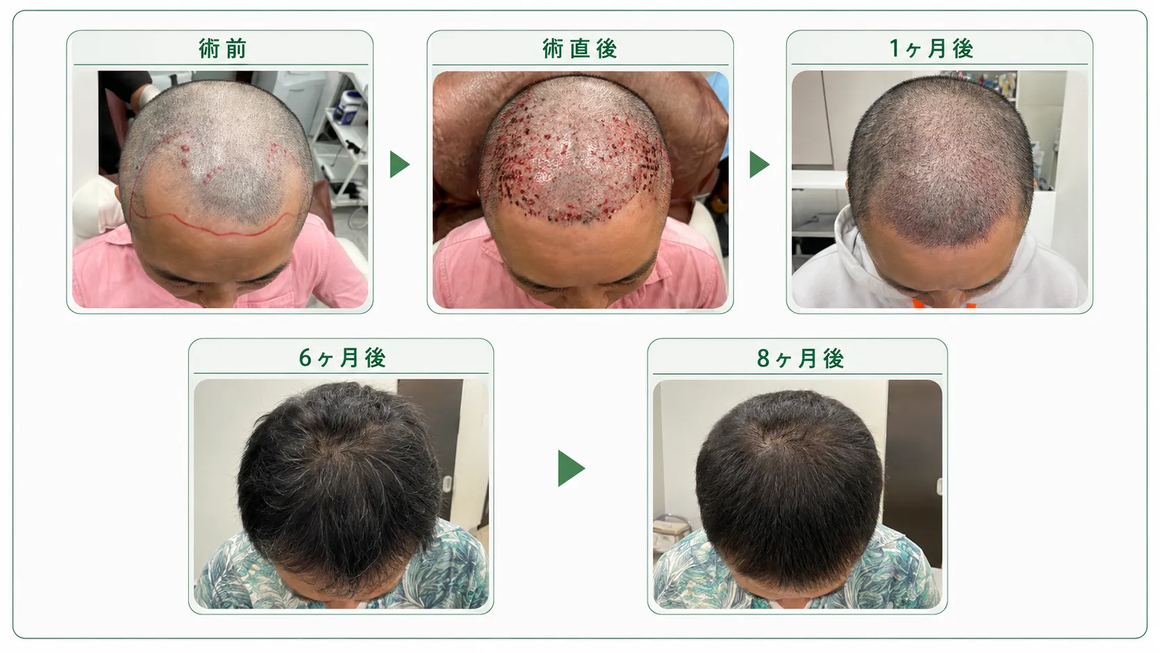 頭頂部の自毛植毛 Before / Afterの症例写真