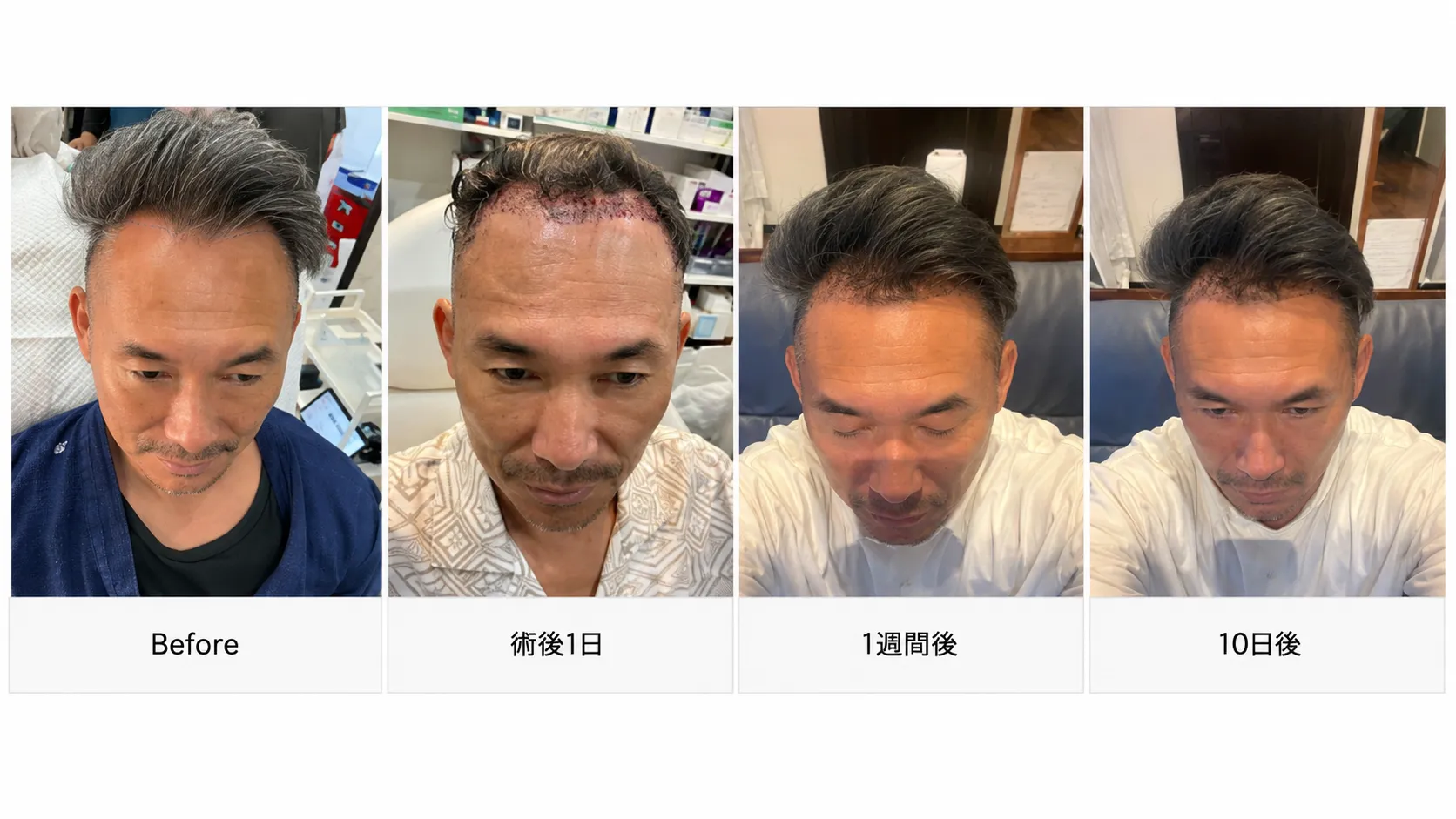 M字・生え際の自毛植毛 Before / Afterの症例写真
