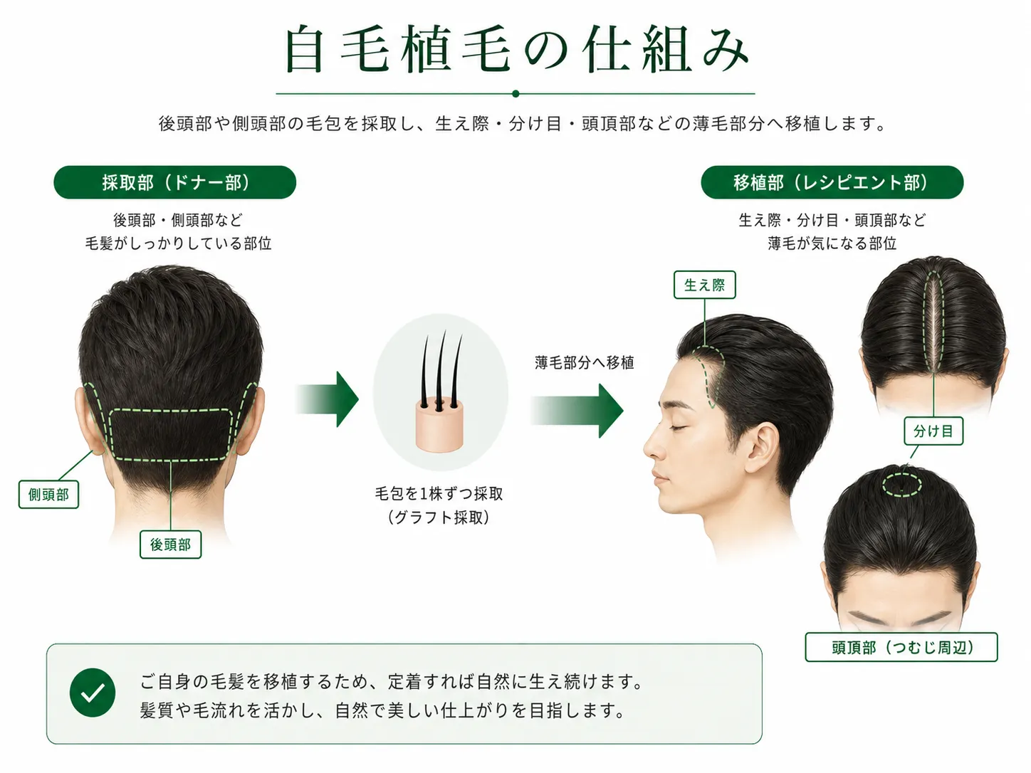 後頭部または側頭部から毛包を採取し、生え際や頭頂部へ移植する自毛植毛の仕組み