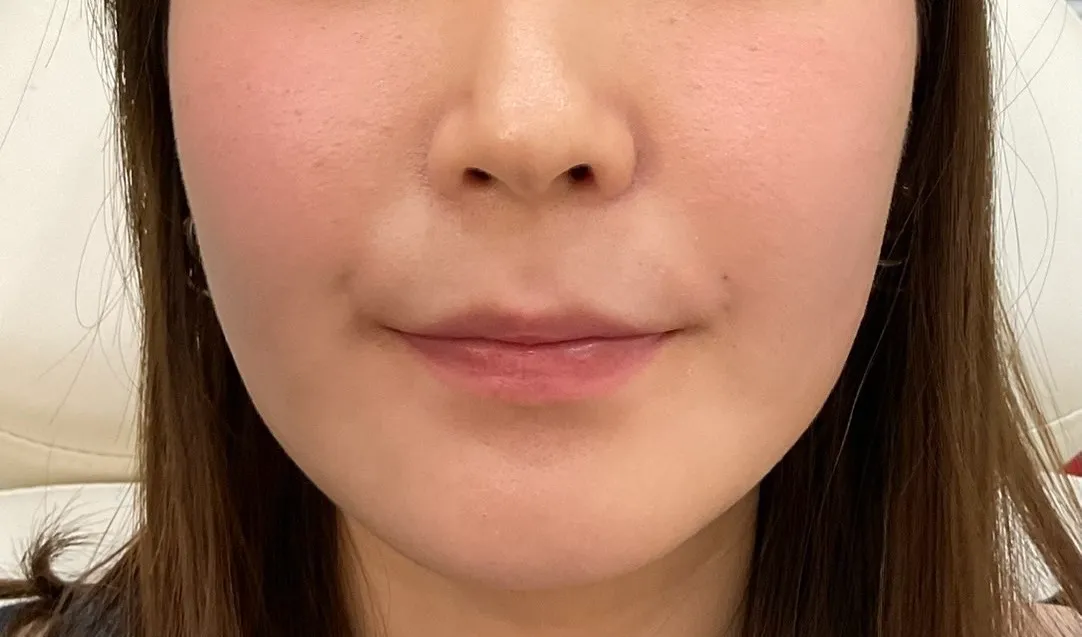 ヒアルロン酸 ボリューマ 頬こけ【症例写真】